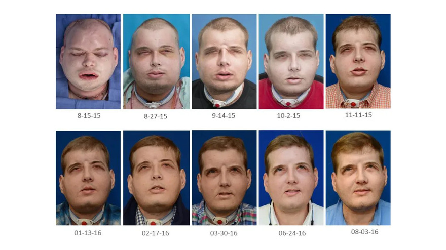 Firefighter suffers third-degree burns – this is him 7 years later