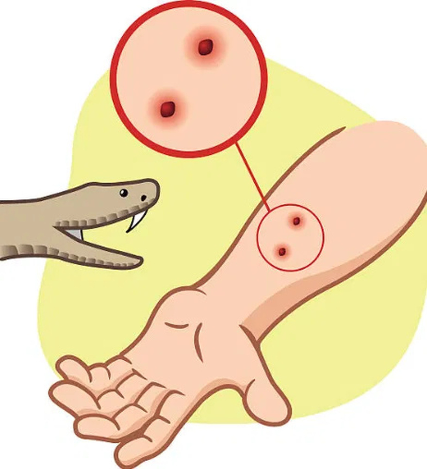 When bitten by a snake, you should do these things first