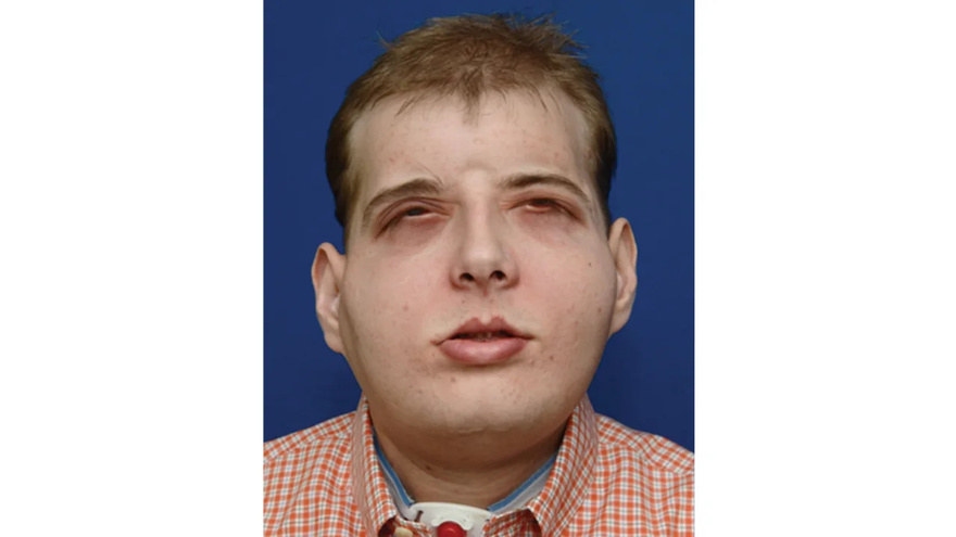 Firefighter suffers third-degree burns – this is him 7 years later