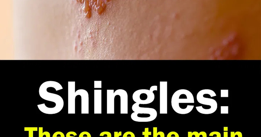 Shingles: Symptoms, Complications and Prevention