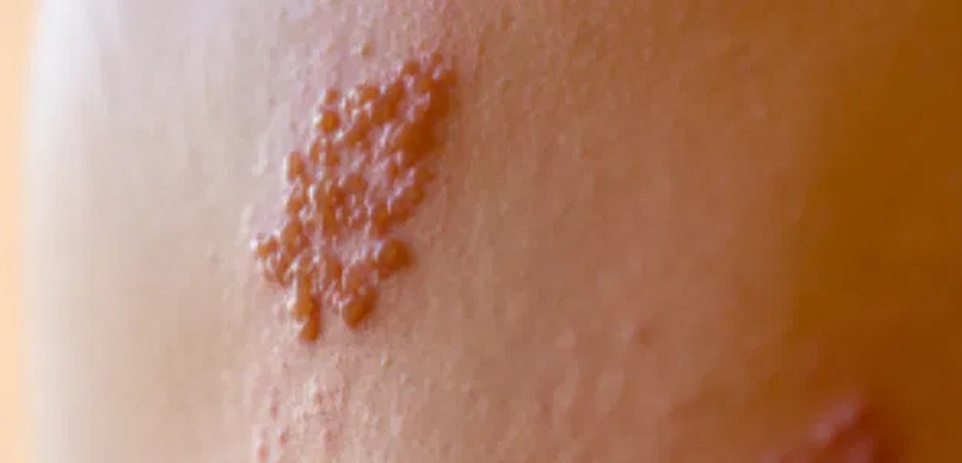 Shingles: Symptoms, Complications and Prevention