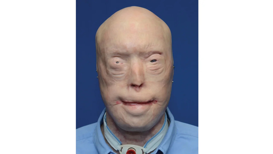Firefighter suffers third-degree burns – this is him 7 years later