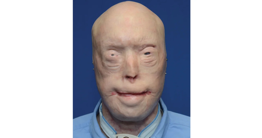 Firefighter suffers third-degree burns – this is him 7 years later