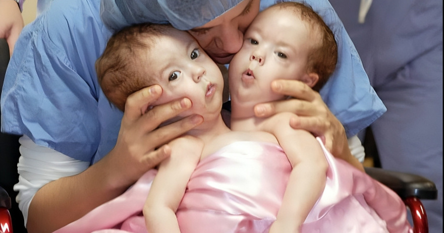 Conjoined Twins Bella And Abby Were Genuinely Associated From Birth, Yet Medical Procedure Changed Everything