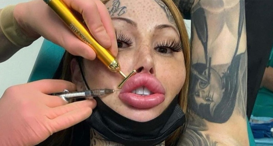 Woman who wants to become a ‘forest elf,’ gets Barbie nose and cat eyes in new extreme procedure