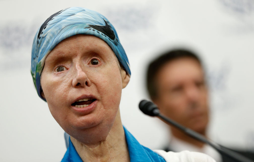 The sad story of Charla Nash, the woman whose face was ripped off by an chimpanzee