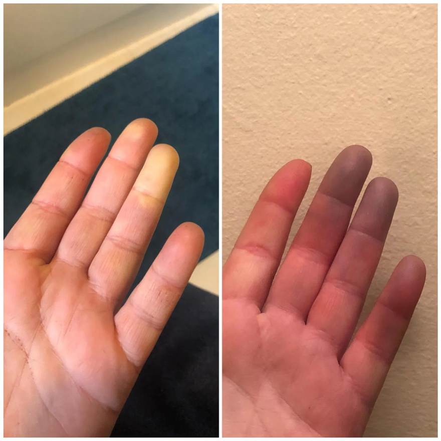 Why do fingers change color?