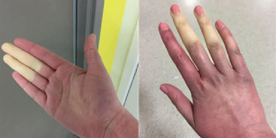 Why do fingers change color?