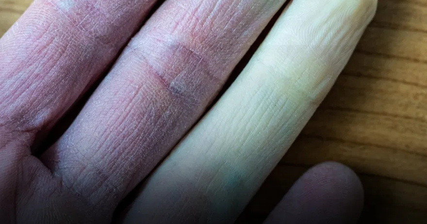 Why do fingers change color?