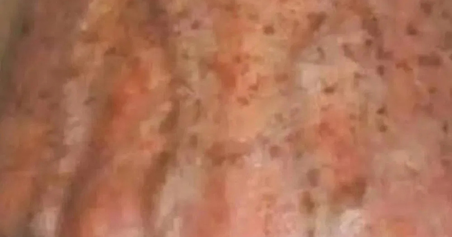Did you know that if you get SPOTS on your HANDS it is a sign that you suffer from