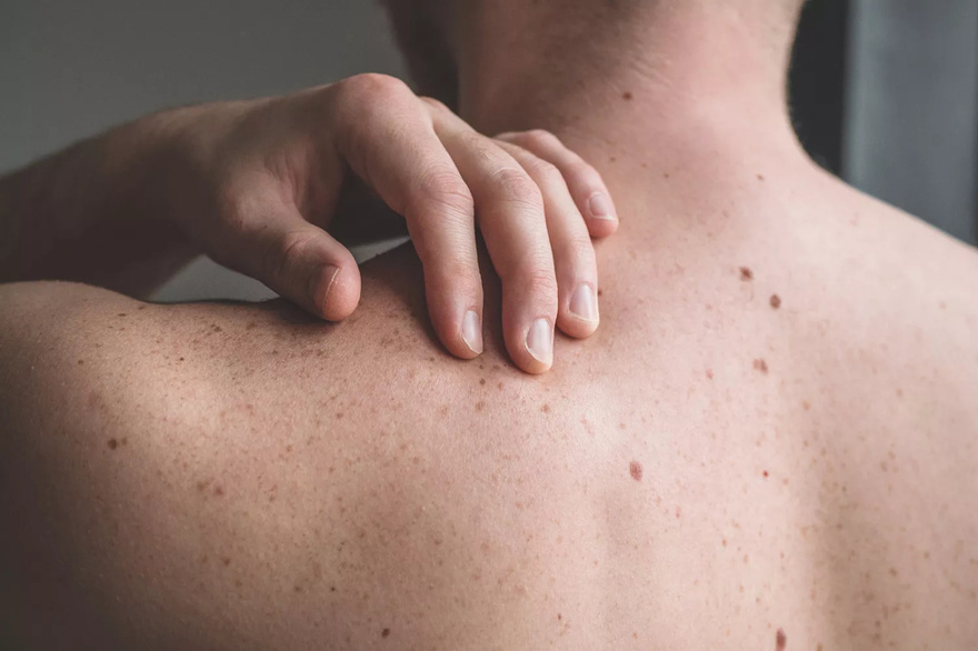 Teen Diagnosed with Stage 3 Melanoma at 15 Says Doctors Initially Dismissed Cancer Symptom as Sign of ‘Puberty’