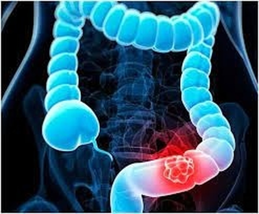 10 symptoms of bowel can.cer