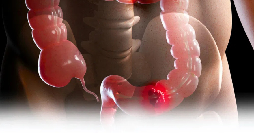10 symptoms of bowel can.cer