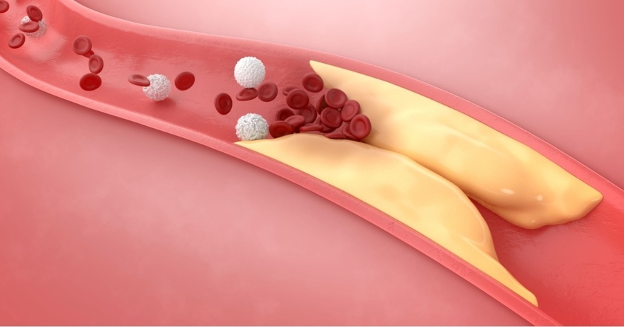 10 Signs You’re Living With Clogged Arteries