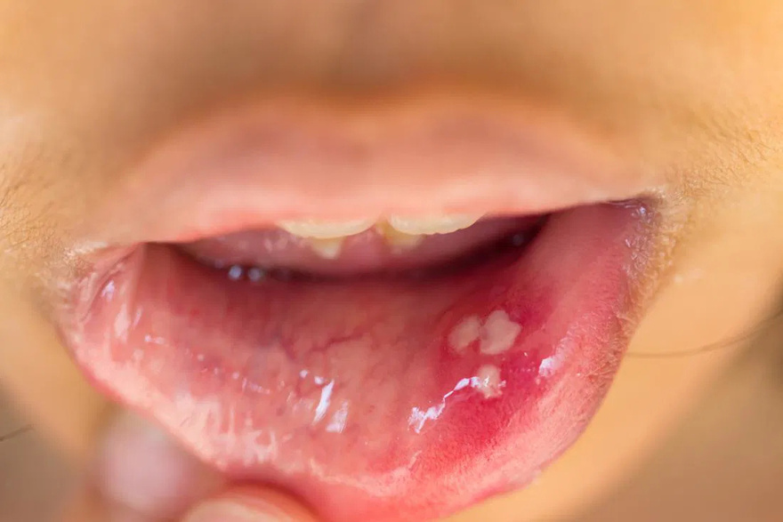 What symptoms does HPV cause in the throat?