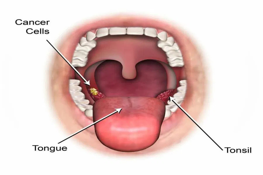 What symptoms does HPV cause in the throat?