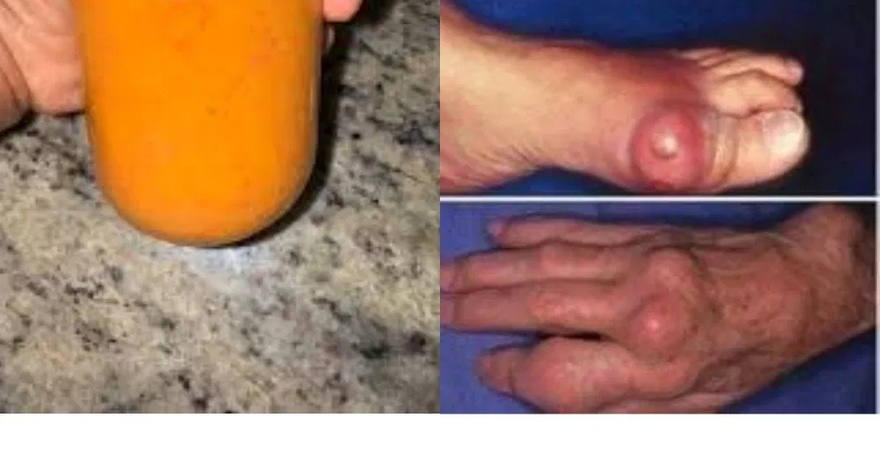 Benefits of This Ingredient to Eliminate Gout and Uric Acid.