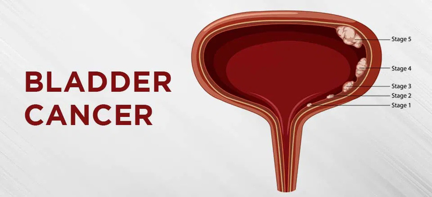 Bladder Can.cer Is a Hidden Danger: 10 War:ning Signs You Shouldn’t Ignore