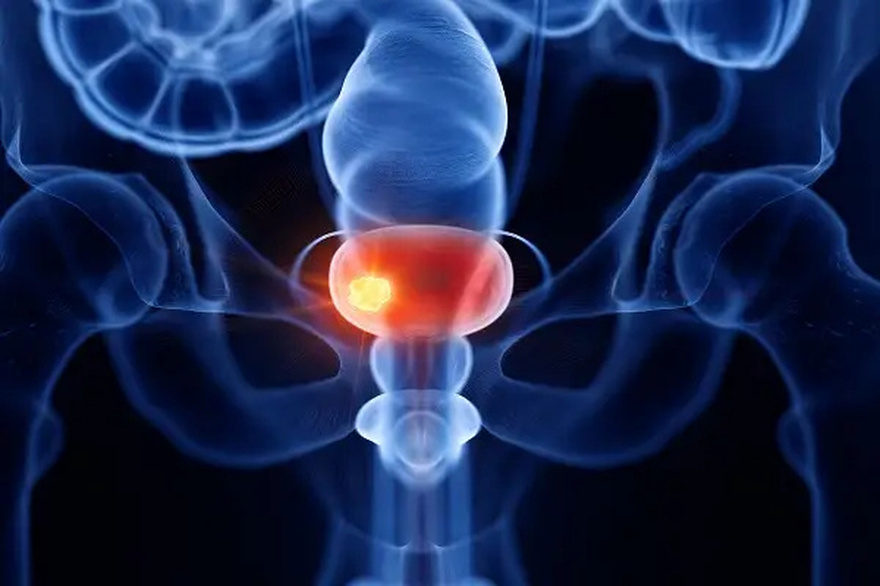 Bladder Can.cer Is a Hidden Danger: 10 War:ning Signs You Shouldn’t Ignore