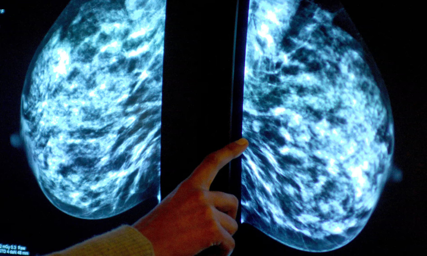 A new type of Artificial Intelligence can detect breast cancer 5 years before diagnosis