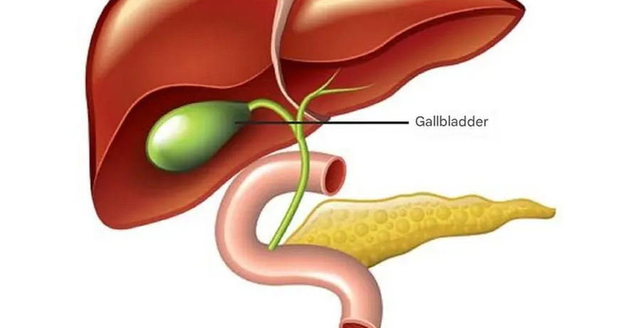 What Happens to the Body After Gallbladder Removal? 3 Diseases That May Follow – Avoid Surgery If Possible