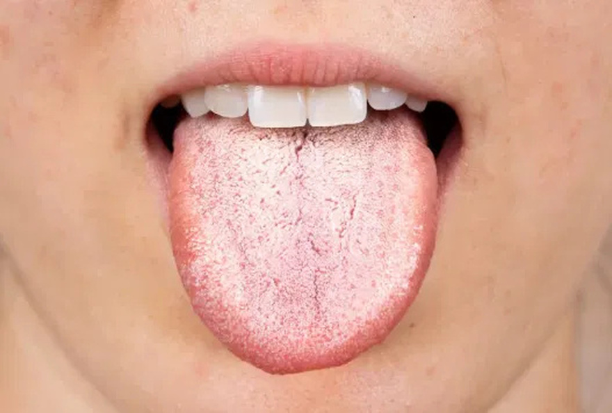 Oral Can.cer: Symptoms You Shouldn’t Ignore.