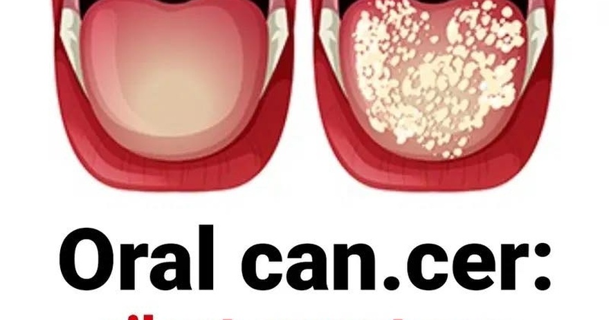 Oral Can.cer: Symptoms You Shouldn’t Ignore.