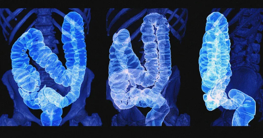 A saturated colon: when the body sounds the alarm