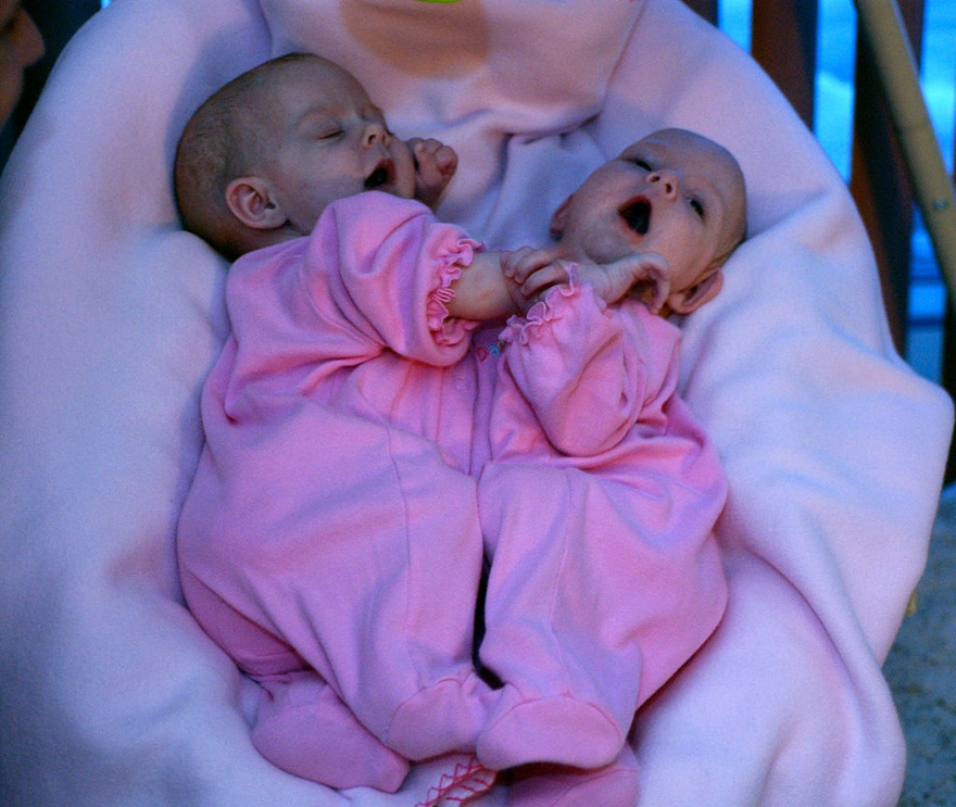 Siamese twins underwent separation surgery in 2006 – how they look today