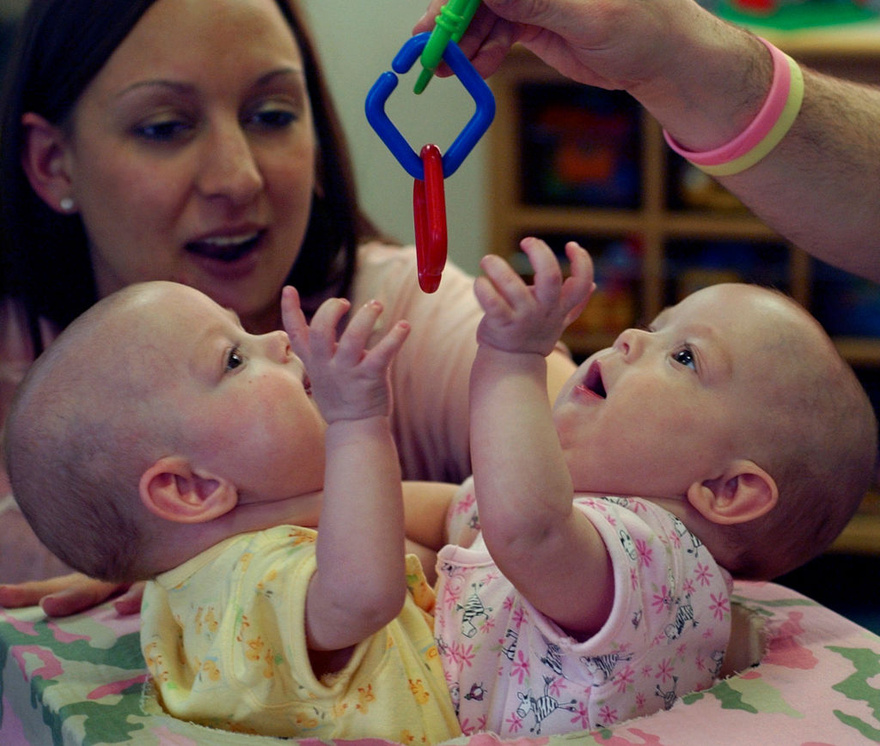 Siamese twins underwent separation surgery in 2006 – how they look today