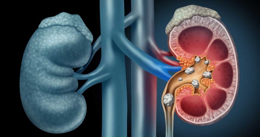 If Your Kidneys Are in Danger, the Body Will Show these 10 Signs