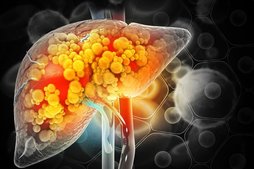 Fatty Liver: Causes, Symptoms, Treatment & Home Remedies