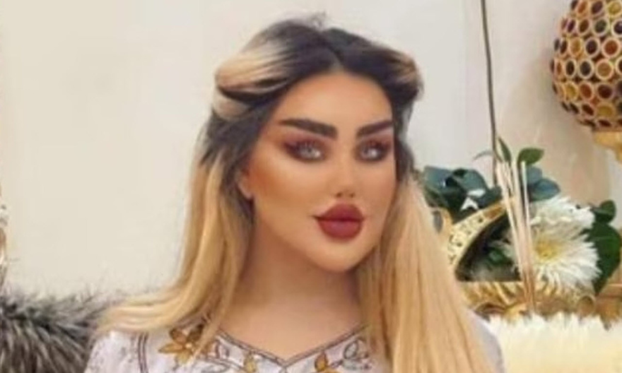 Woman Has 43 Surgeries To Look Like A Doll But She Looks Like A Zombie.