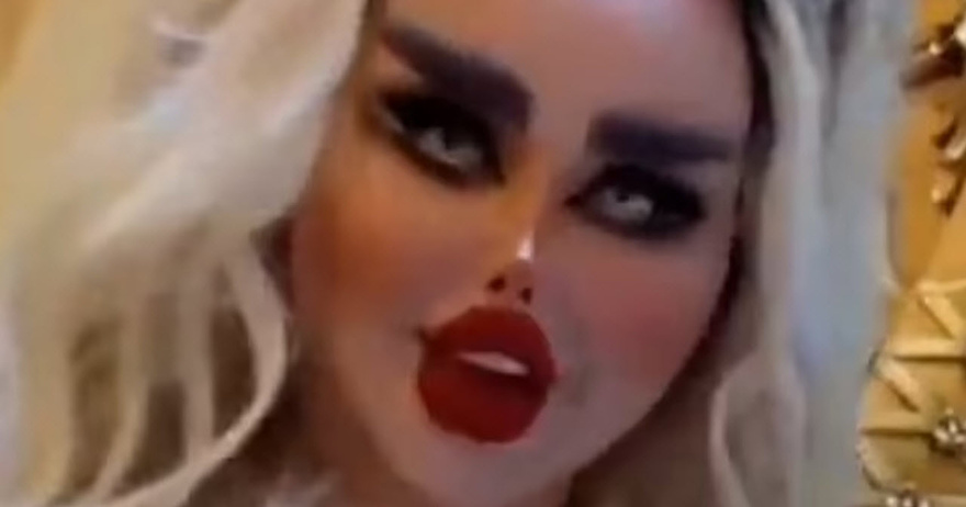 Woman Has 43 Surgeries To Look Like A Doll But She Looks Like A Zombie.