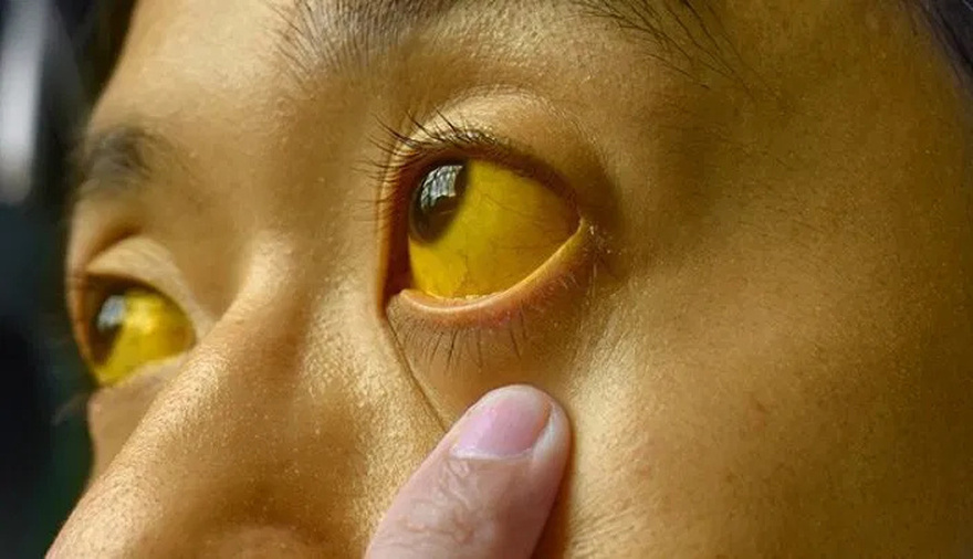 When an internal canc3r sends war:ning signals to your eyes, don’t ignore them!