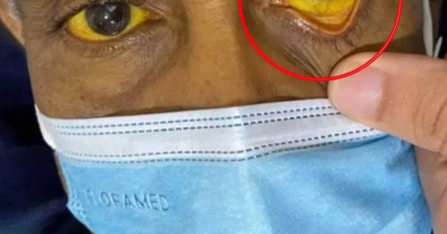 When an internal canc3r sends war:ning signals to your eyes, don’t ignore them!