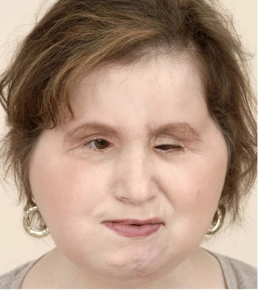 The amazing story of Katie Stubblefield: She became the youngest person to receive a face transplant