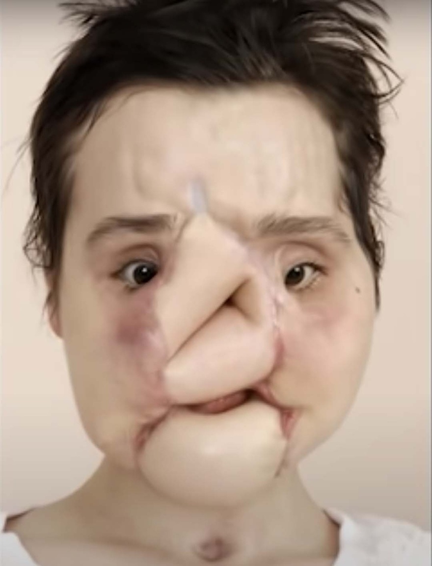 The amazing story of Katie Stubblefield: She became the youngest person to receive a face transplant