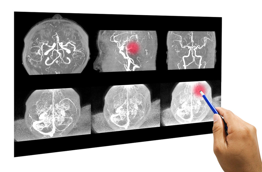 12 Early Warning Signs of an Aneurysm You Shouldn’t Ignore
