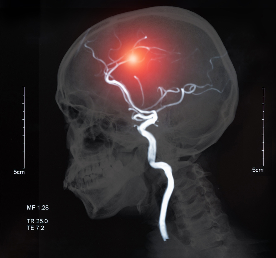 12 Early Warning Signs of an Aneurysm You Shouldn’t Ignore