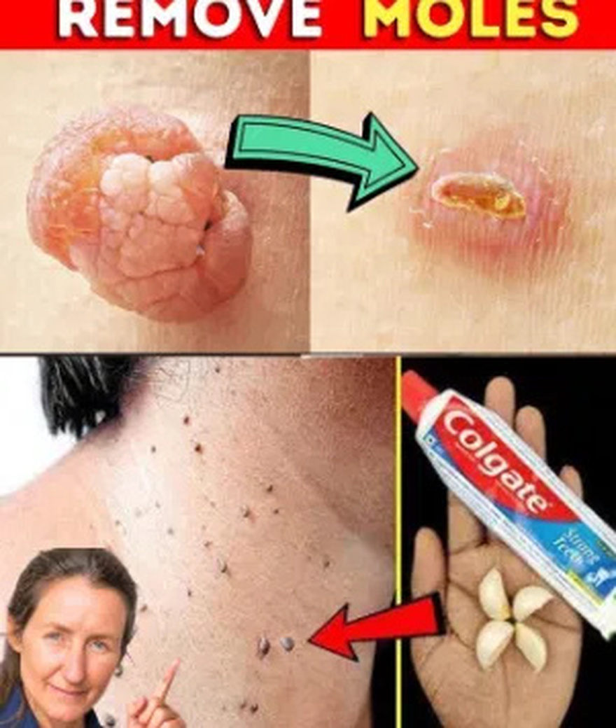 Plantar Warts and Skin Tags Disappear Naturally—Try This Overnight Remedy