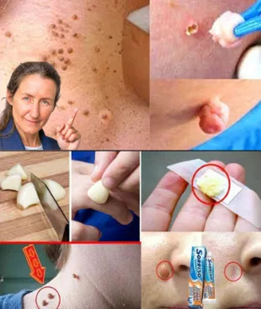 Plantar Warts and Skin Tags Disappear Naturally—Try This Overnight Remedy