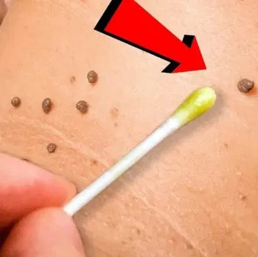 Plantar Warts and Skin Tags Disappear Naturally—Try This Overnight Remedy